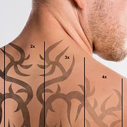 Laser Tattoo Removal