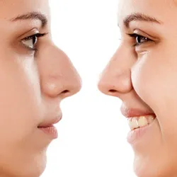 Nose Job – Liquid Rhinoplasty