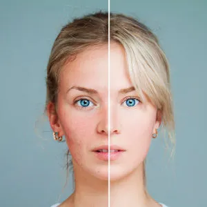 Chemical Peel Essex at skinlabbeautyclinic.com Hornchurch UK