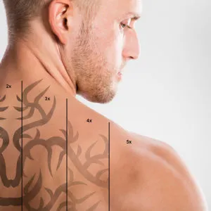 Laser Tattoo Removal Essex at skinlabbeautyclinic.com Hornchurch UK