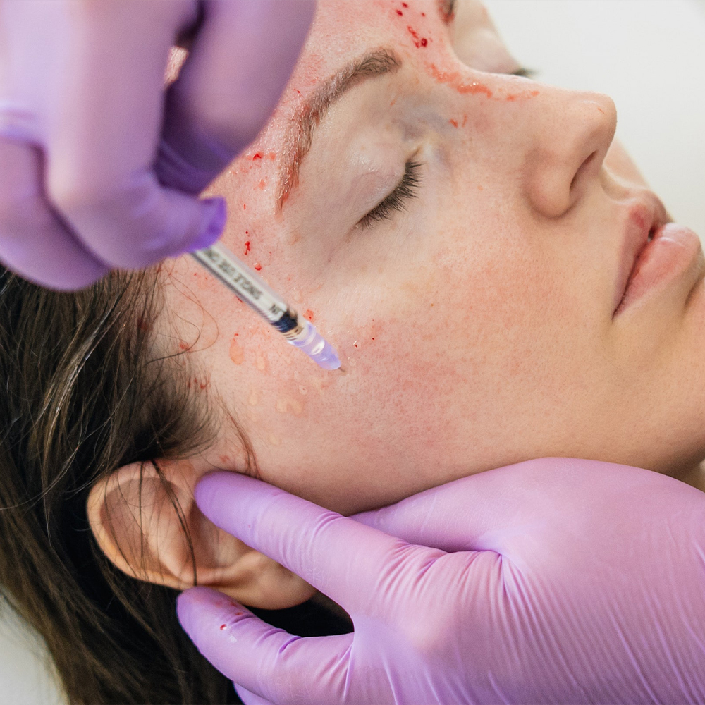 Vampire lifting PRP
