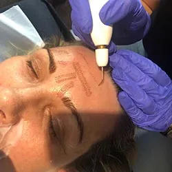 Plasma Fibroblast Treatment