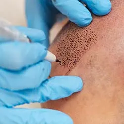 Scalp Micropigmentation
