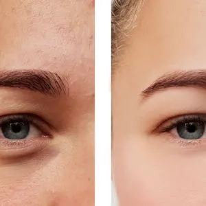 Tear Through Essex at skinlabbeautyclinic.com Hornchurch UK