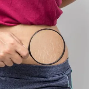 Stretch Marks at skinlabbeautyclinic.com Hornchurch UK