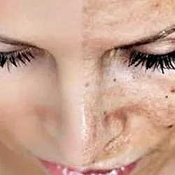 Glycolic Peel