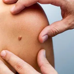 Laser Mole Removal