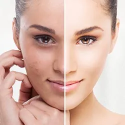 Cosmelan Pigmentation