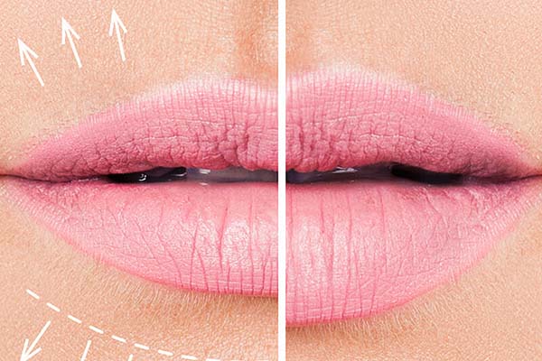 Cosmetic-Injecting-Lip-Flip Cosmetic Injecting Lip Flip at skinlabbeautyclinic.com Hornchurch UK