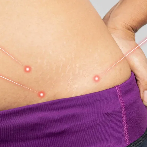 Laser Lipo