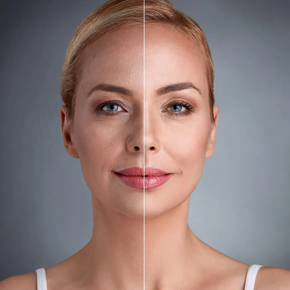 Endolift