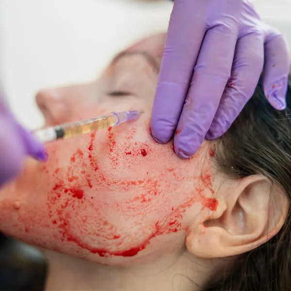 PRP Vampire Lift (Face, Hair & Décolletage)