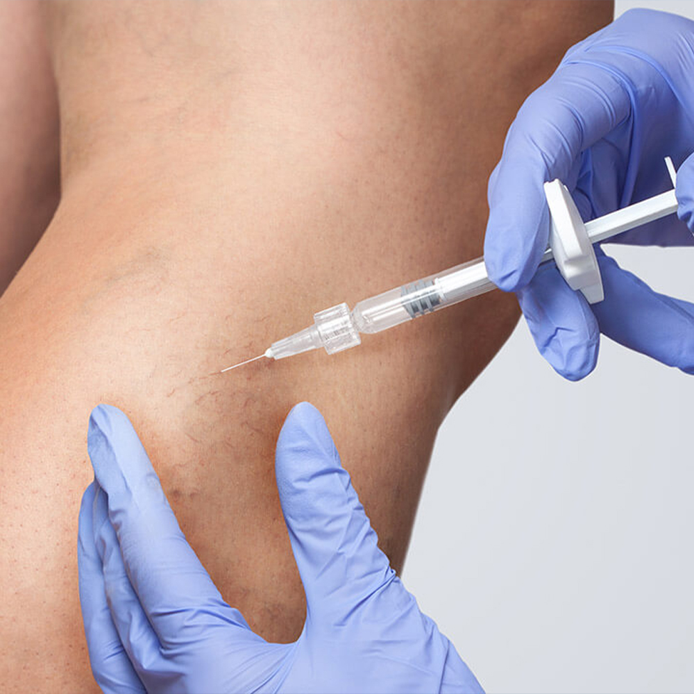 Sclerotherapy Injections