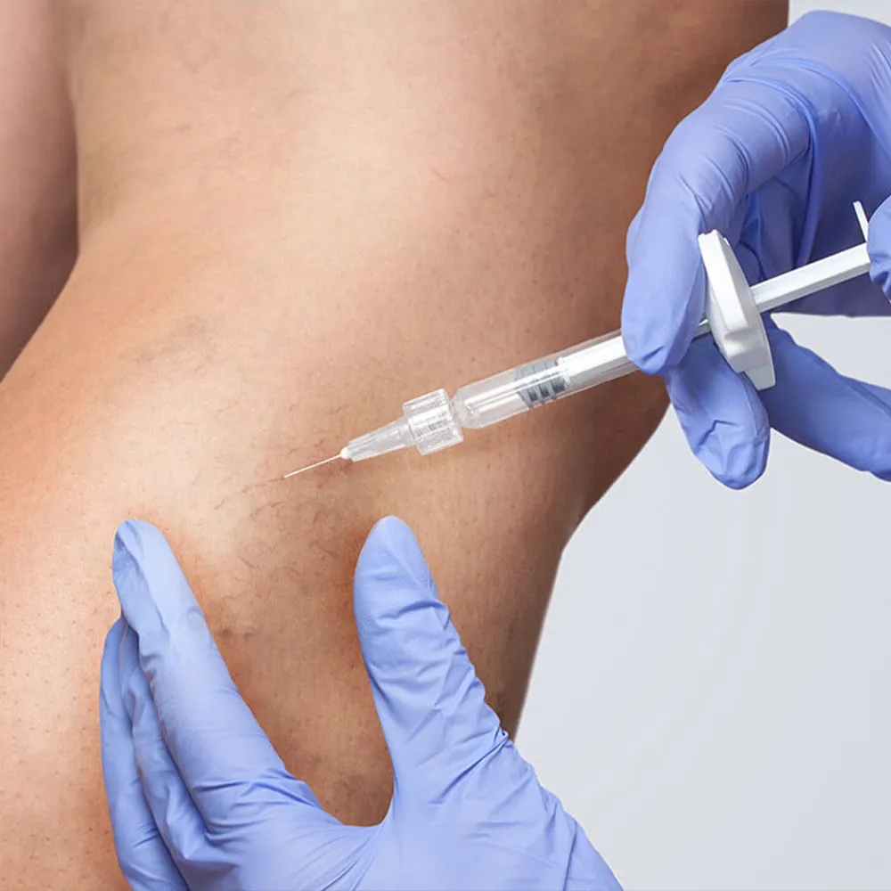 Sclerotherapy Injections