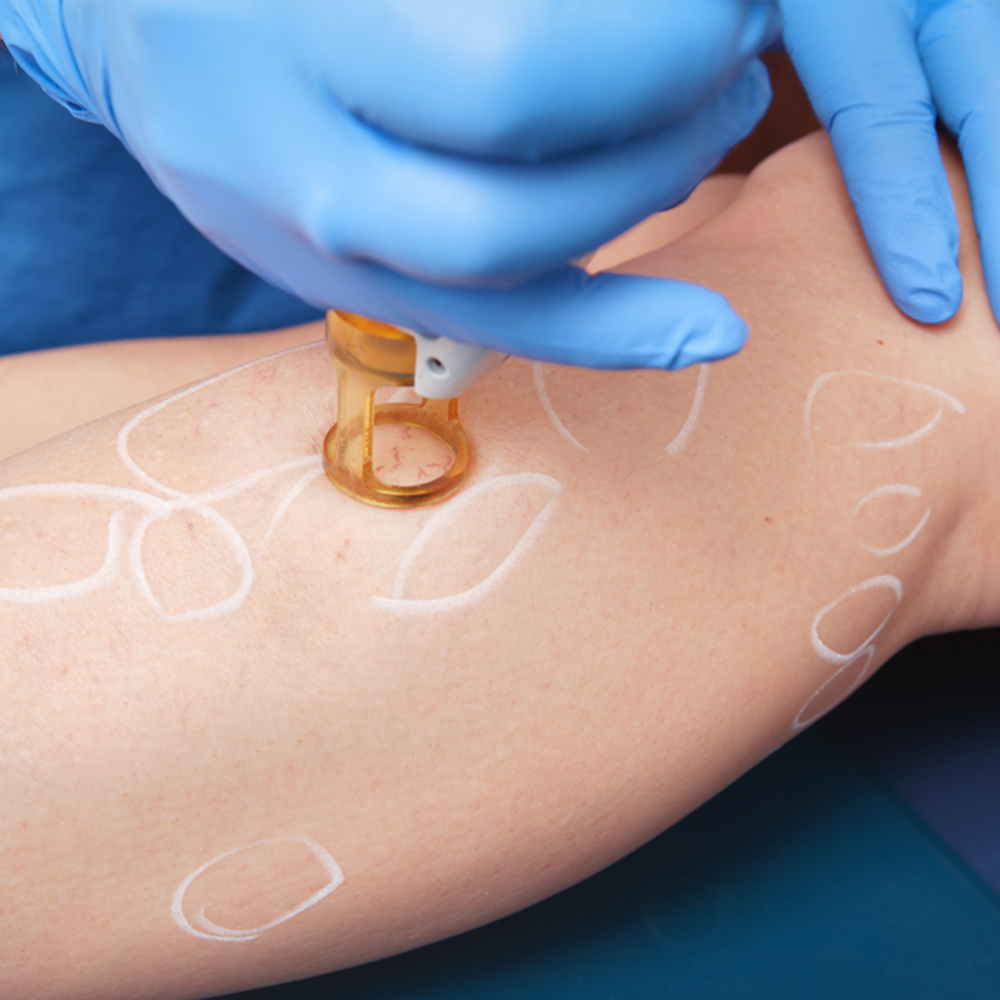 Spider Vein Laser