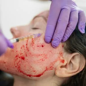 PRP Vampire Lift at skinlabbeautyclinic.com Hornchurch UK