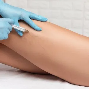 Sclerotheraphy at skinlabbeautyclinic.com Hornchurch UK