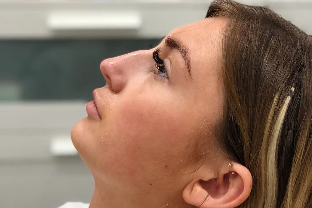 After-Liquid Rhinoplasty