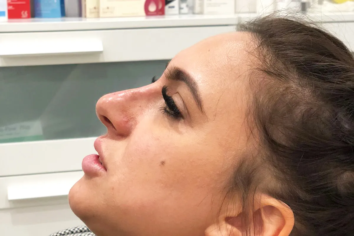 After-Liquid Rhinoplasty