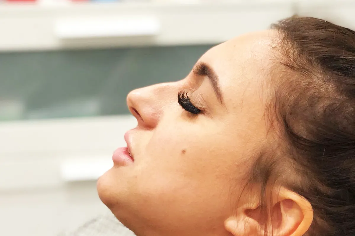 Before-Liquid Rhinoplasty