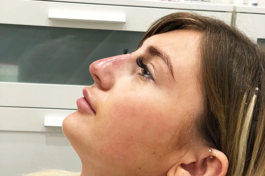 Before-Liquid Rhinoplasty