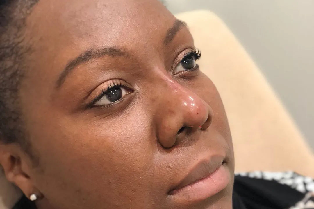After-Liquid Rhinoplasty