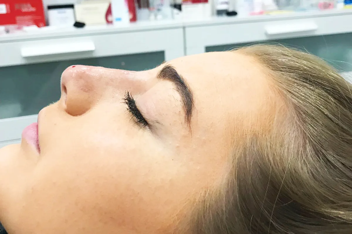 After-Liquid Rhinoplasty