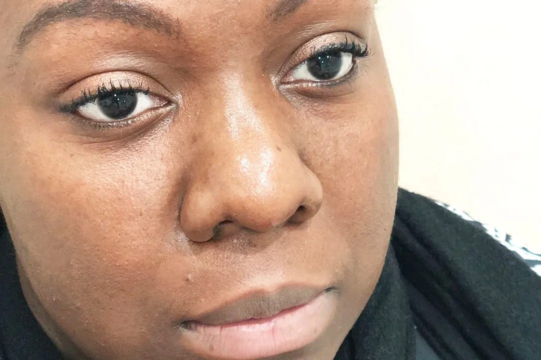 Before-Liquid Rhinoplasty
