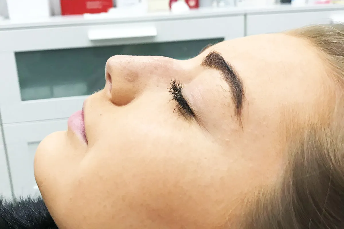 Before-Liquid Rhinoplasty