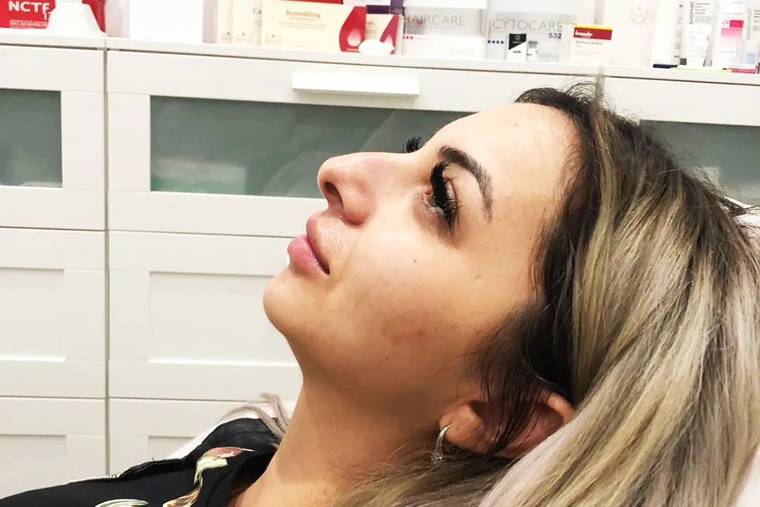 Before-Liquid Rhinoplasty