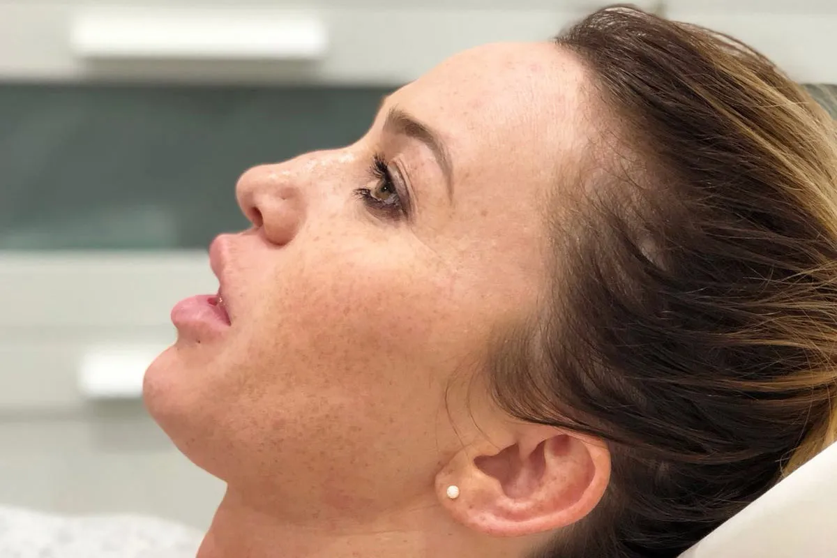Before-Liquid Rhinoplasty