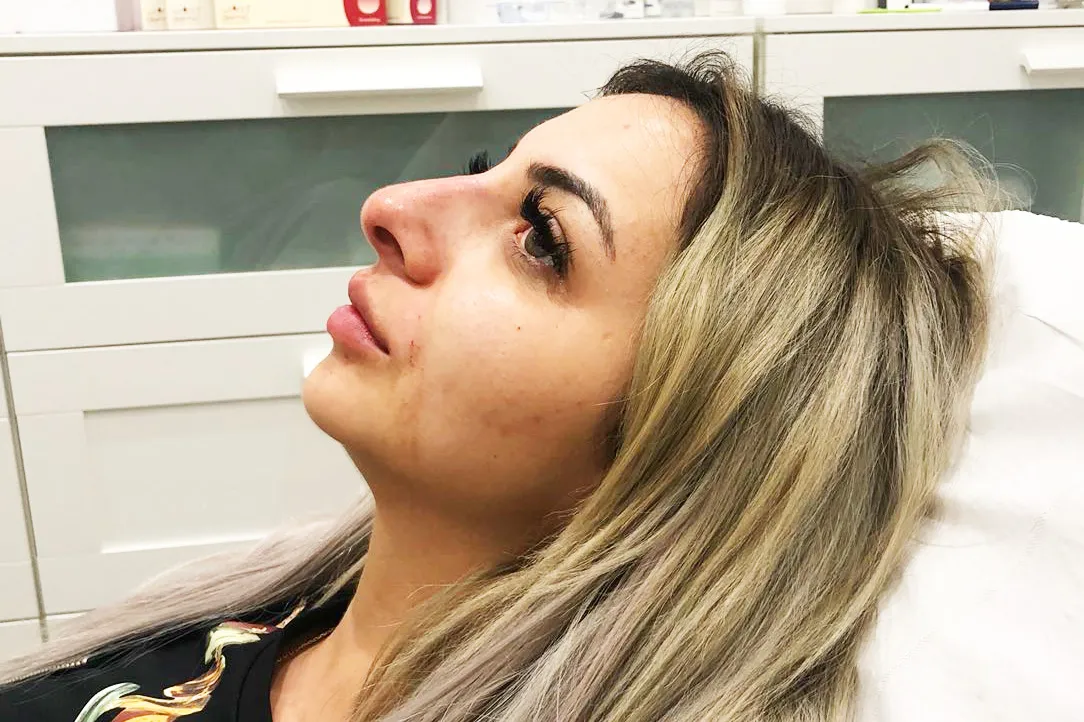 After-Liquid Rhinoplasty
