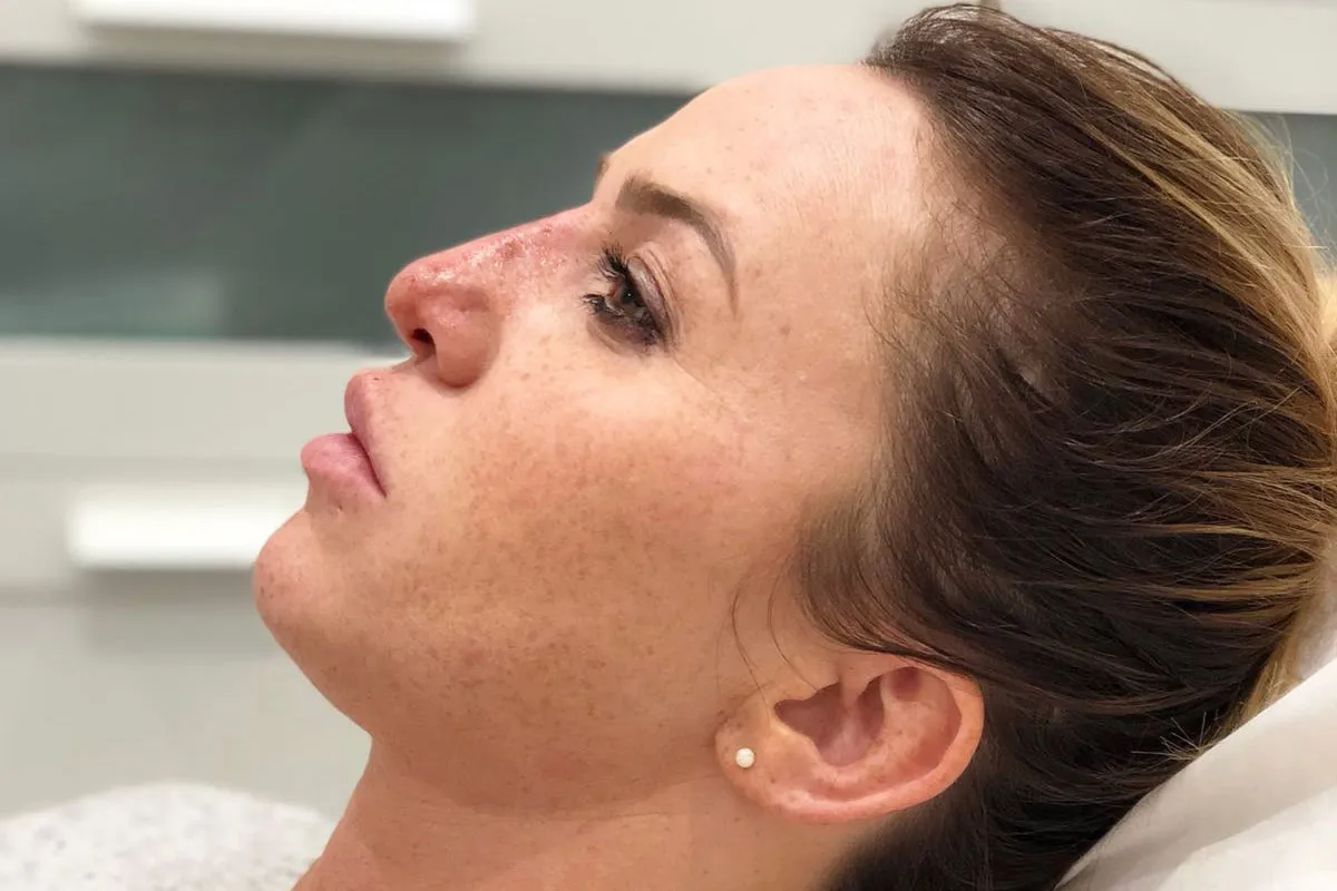 After-Liquid Rhinoplasty