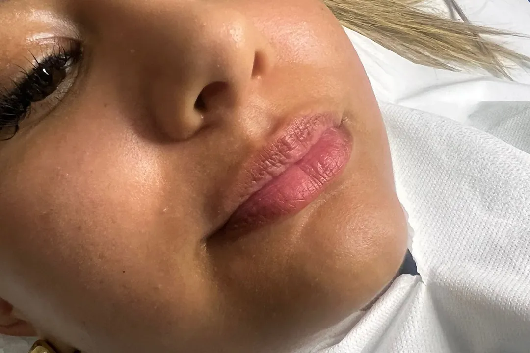 Before-Lip Filler