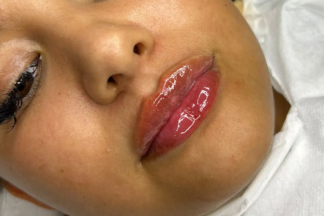 After-Lip Filler
