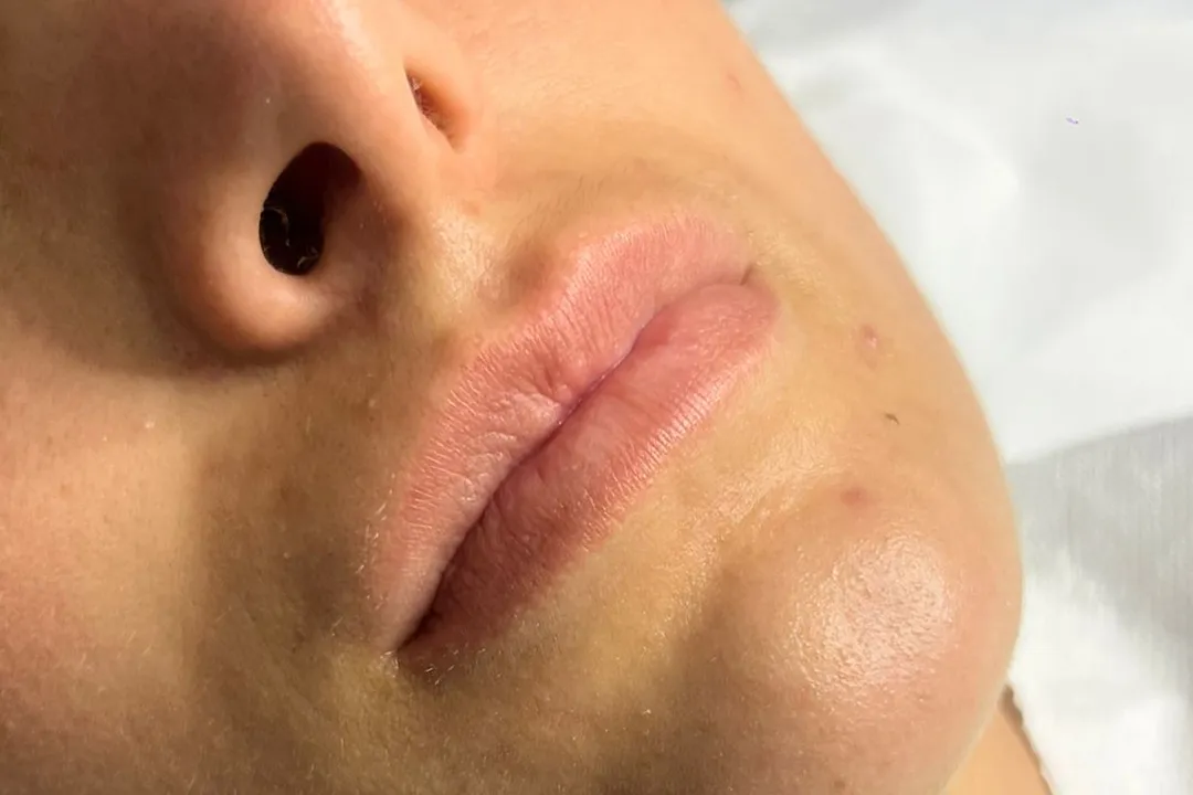 Before-Lip Filler