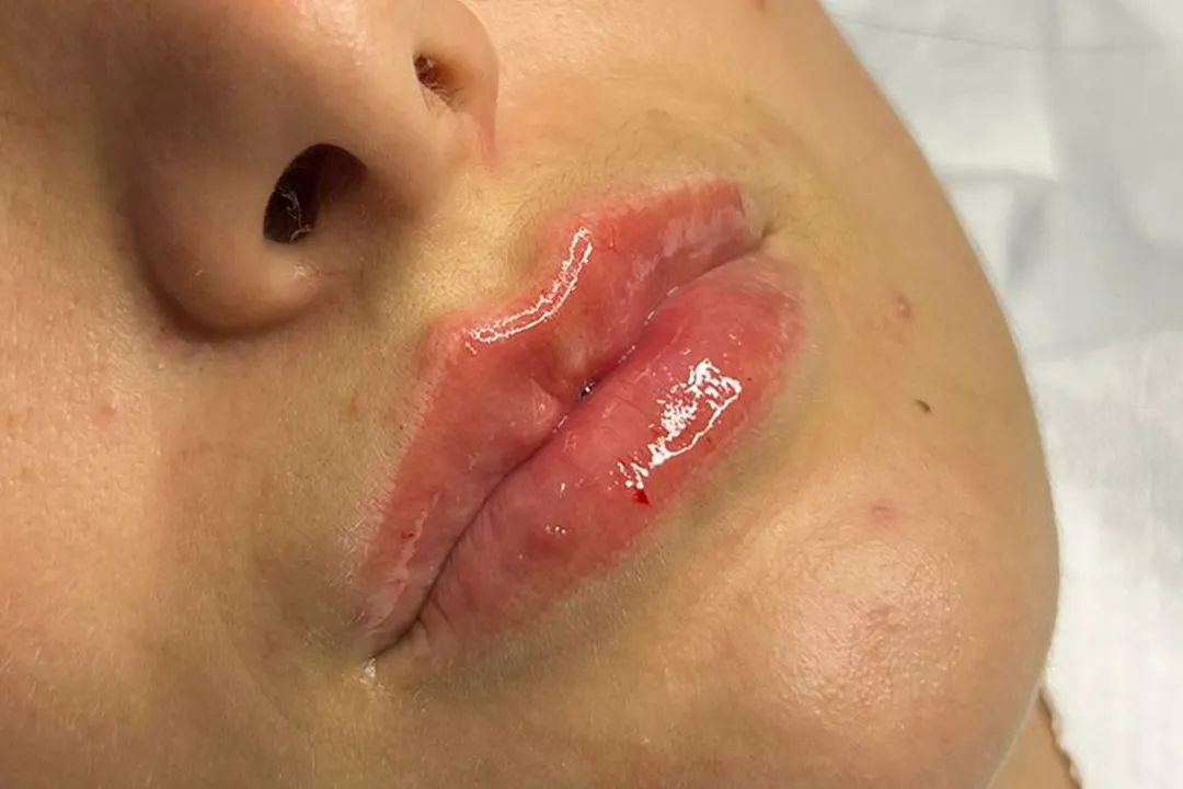 After-Lip Filler