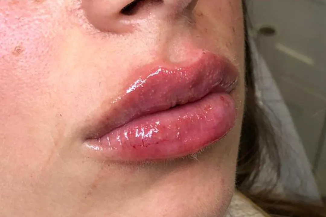 After-Lip Filler
