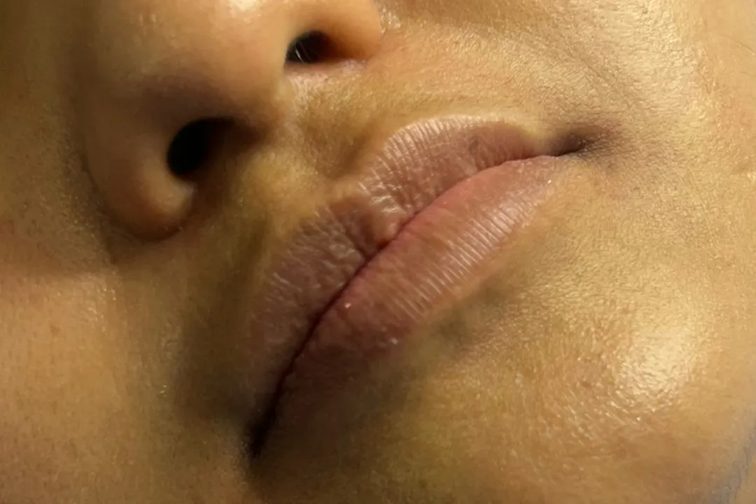 Before-Lip Filler
