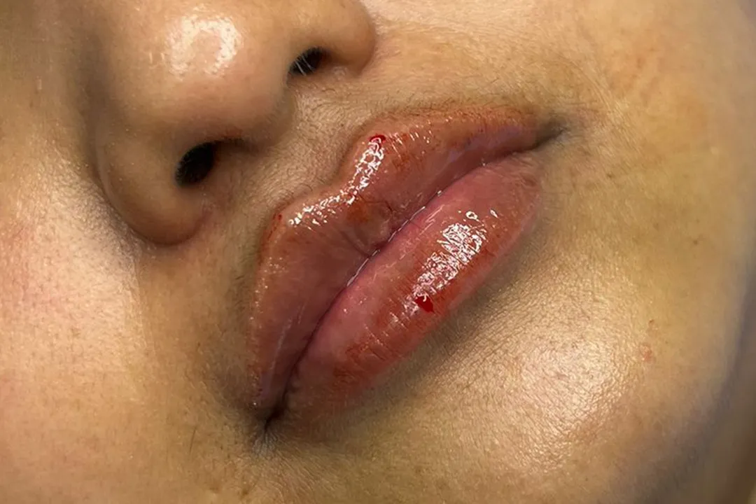 After-Lip Filler