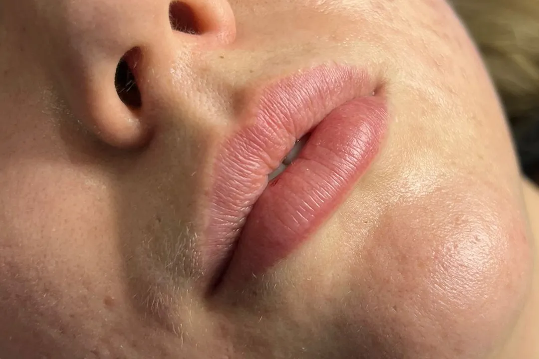 Before-Lip Filler