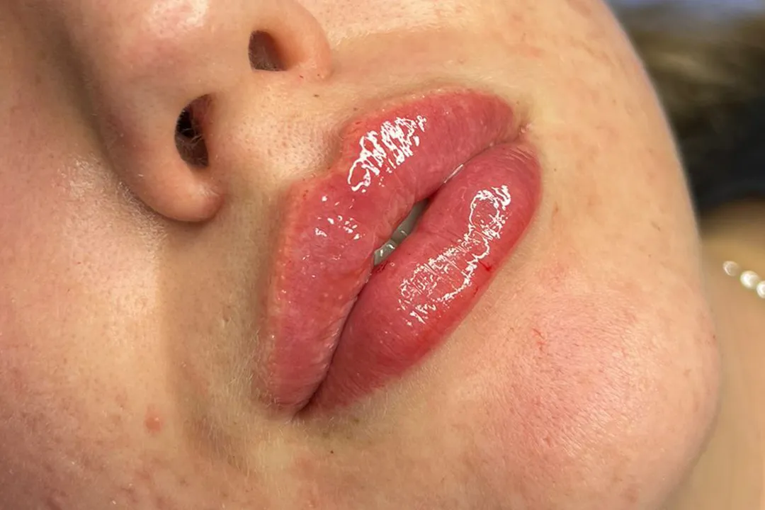 After-Lip Filler