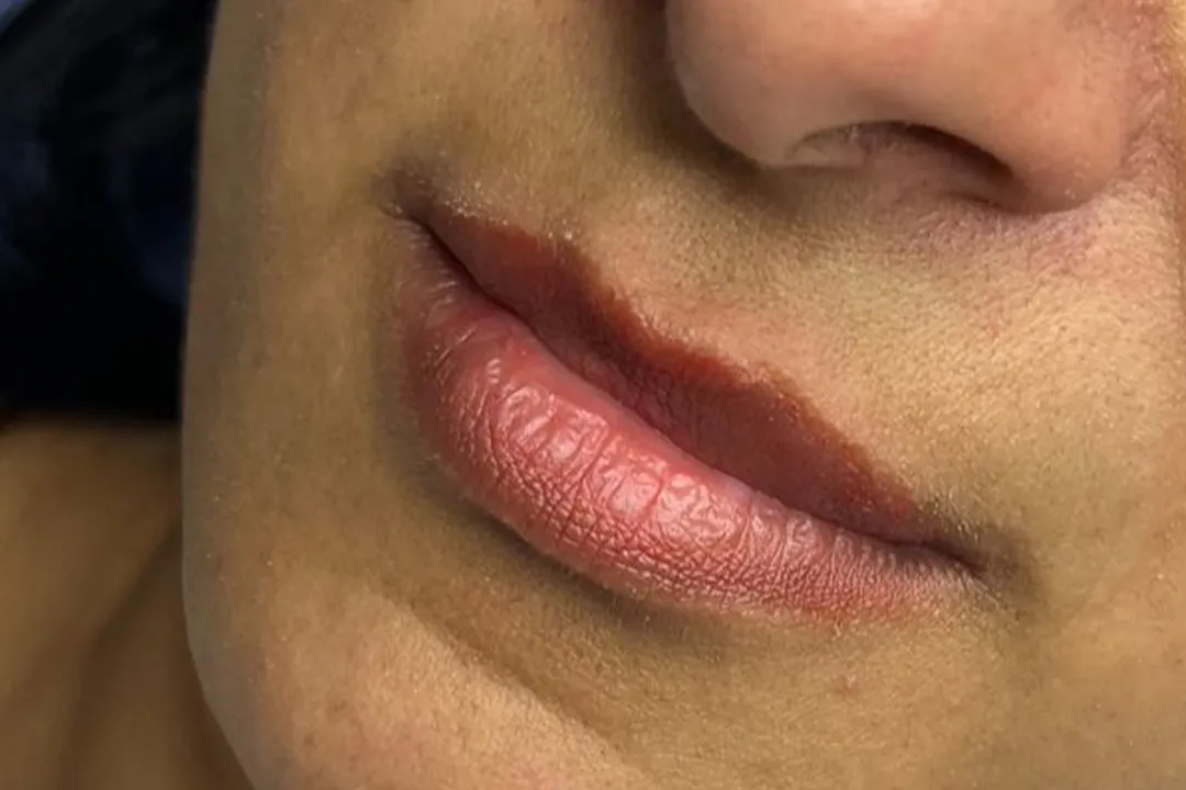 Before-Lip Filler