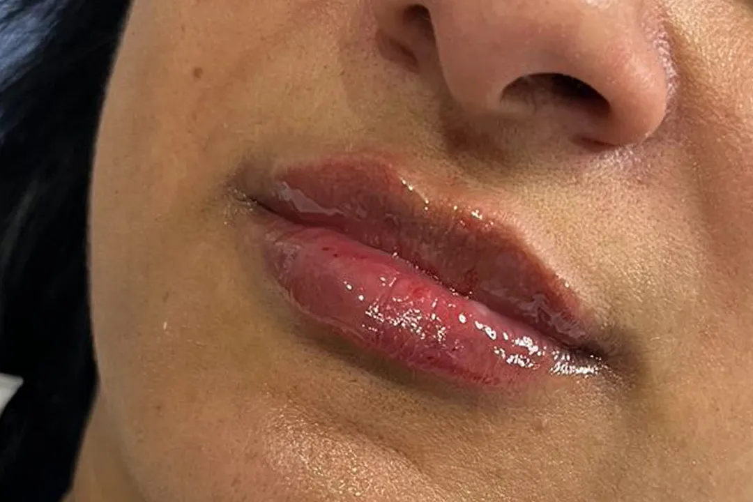 After-Lip Filler