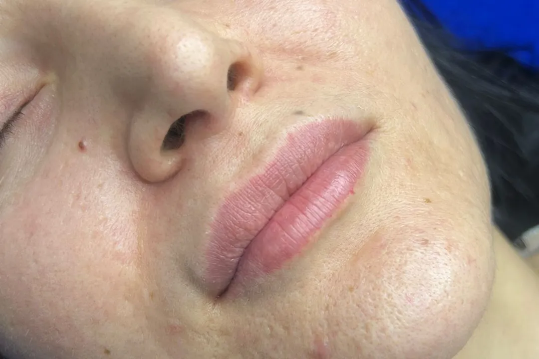 Before-Lip Filler