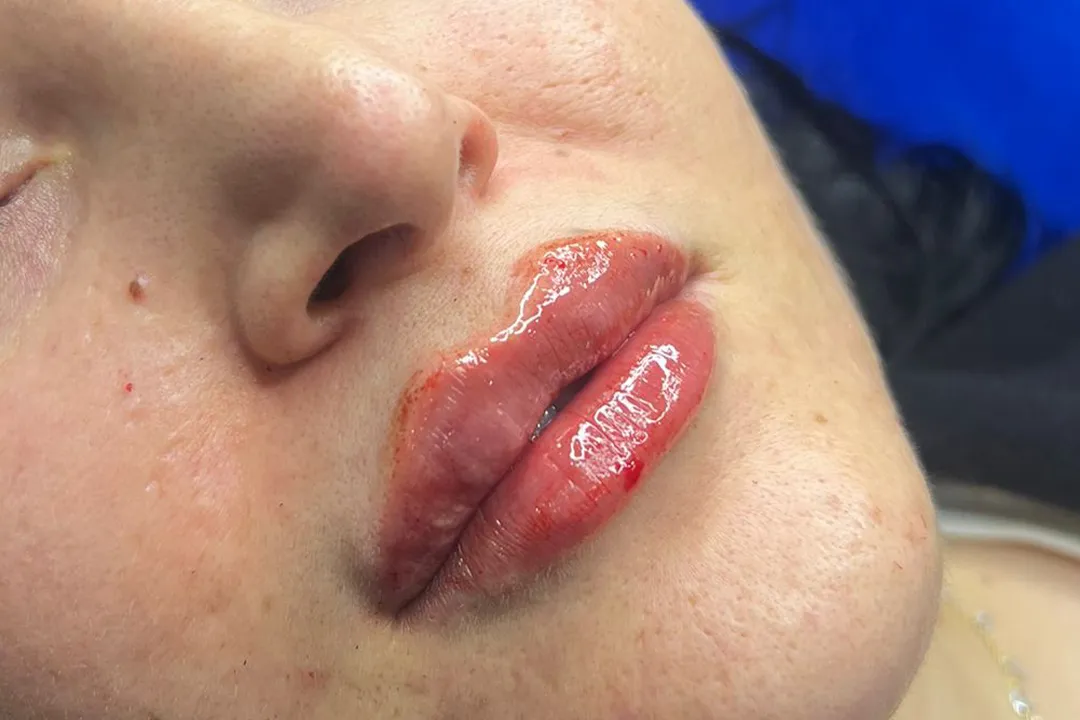 After-Lip Filler