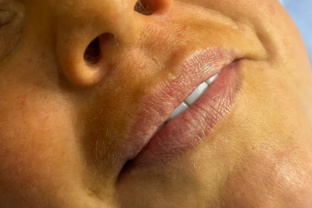 Before-Lip Filler