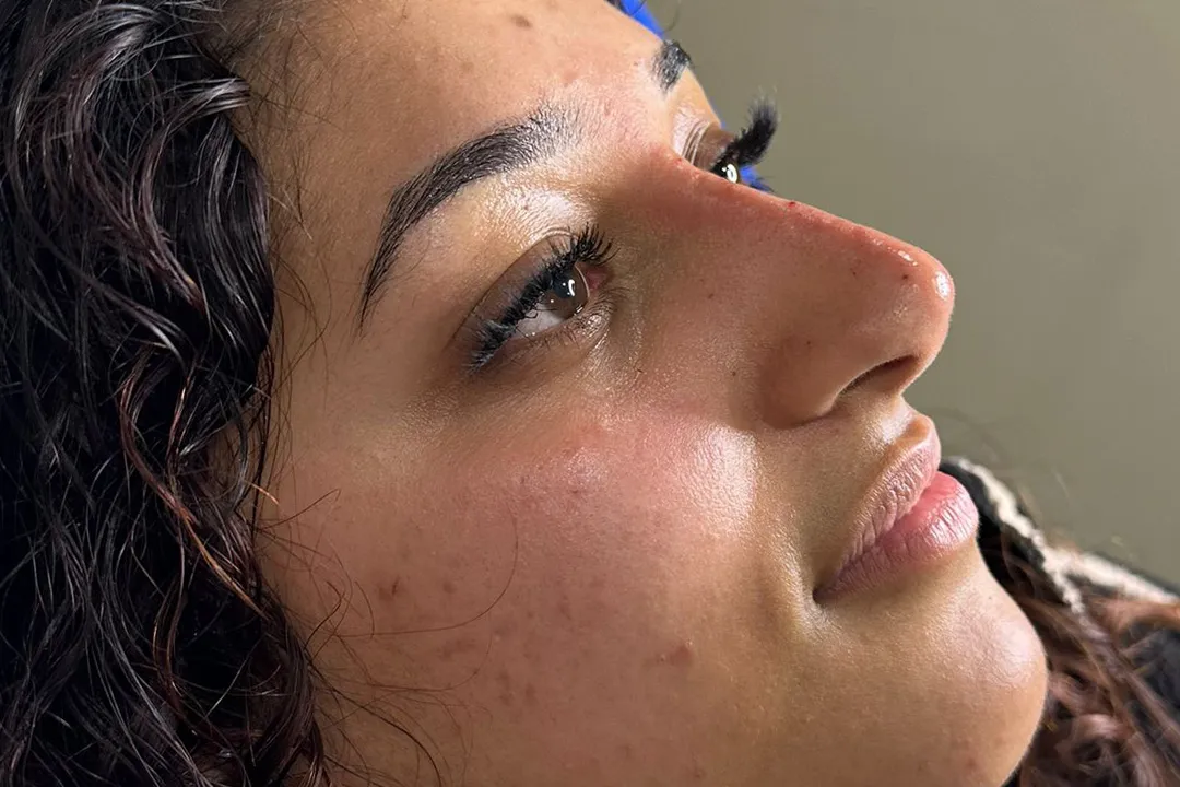 After-Liquid Rhinoplasty