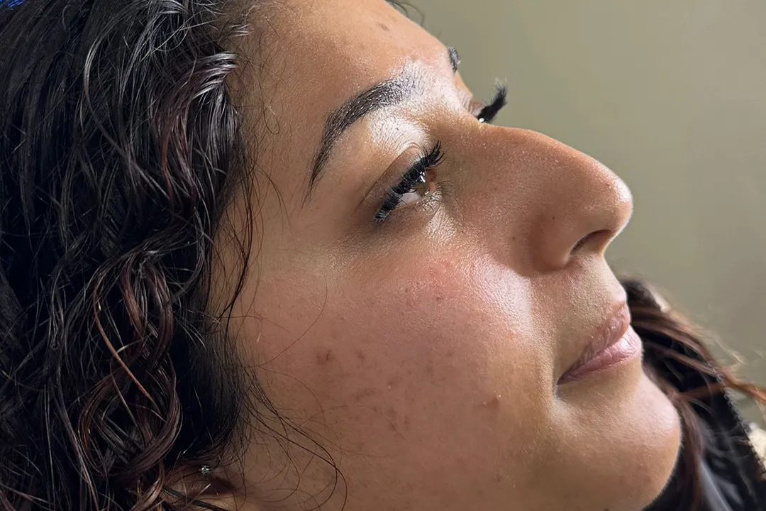 Before-Liquid Rhinoplasty
