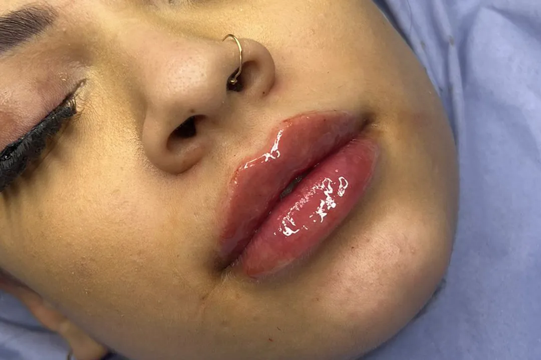After-Lip Filler